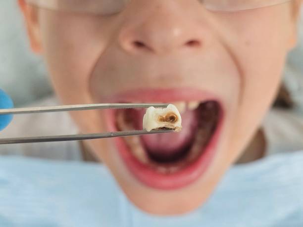 Best Broken or Chipped Tooth Repair in Pinch, WV